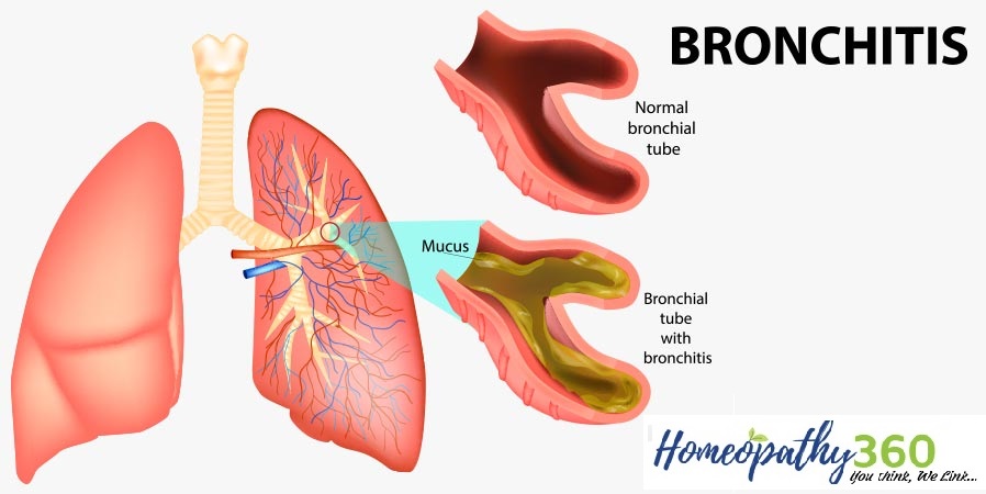 Homeopathic Treatment For Bronchitis