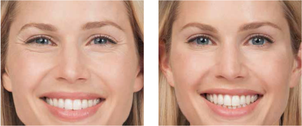 How long does facial paralysis last after Botox