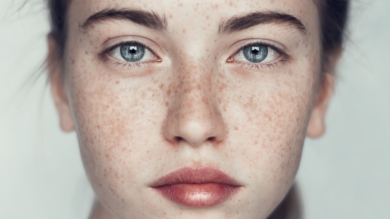 What removes freckles permanently