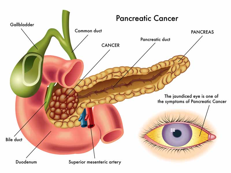 Why is pancreatic cancer not curable