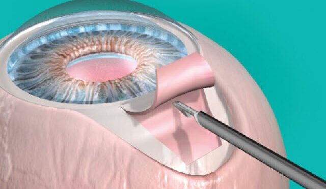 Cataract Glaucoma Surgery
