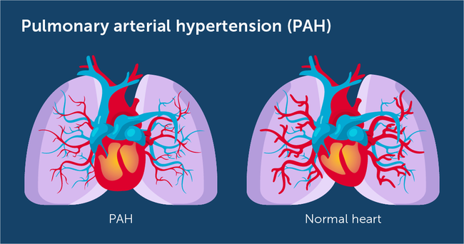 What is the best treatment for pulmonary hypertension