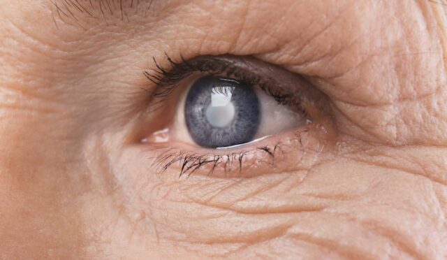 Who Performs Cataract Surgery