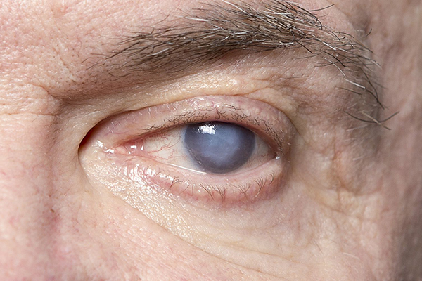 Do cataracts cause high eye pressure