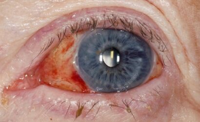 Does Cataract Surgery Reduce Eye Pressure