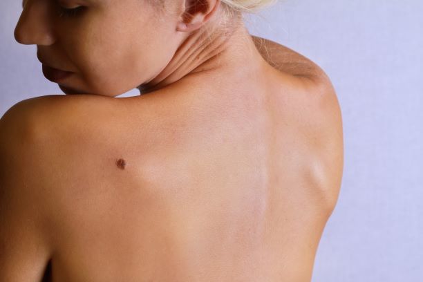 Does Skin Cancer Come Back 