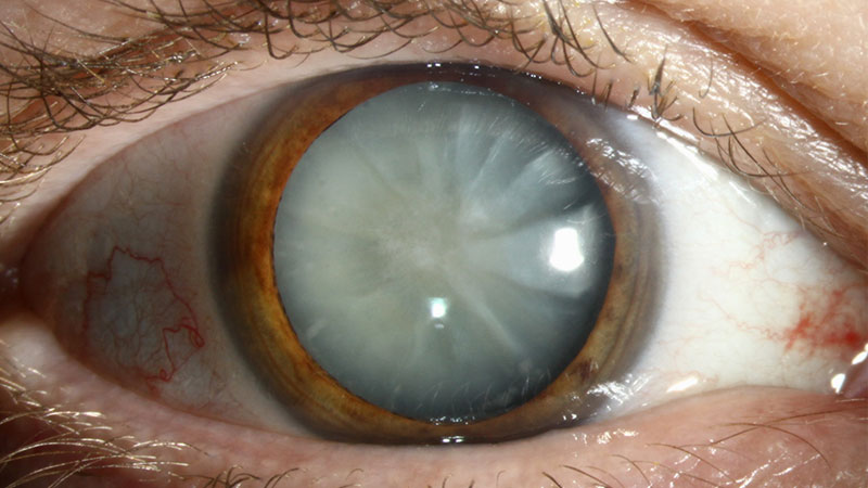 Does glaucoma go away after cataract surgery