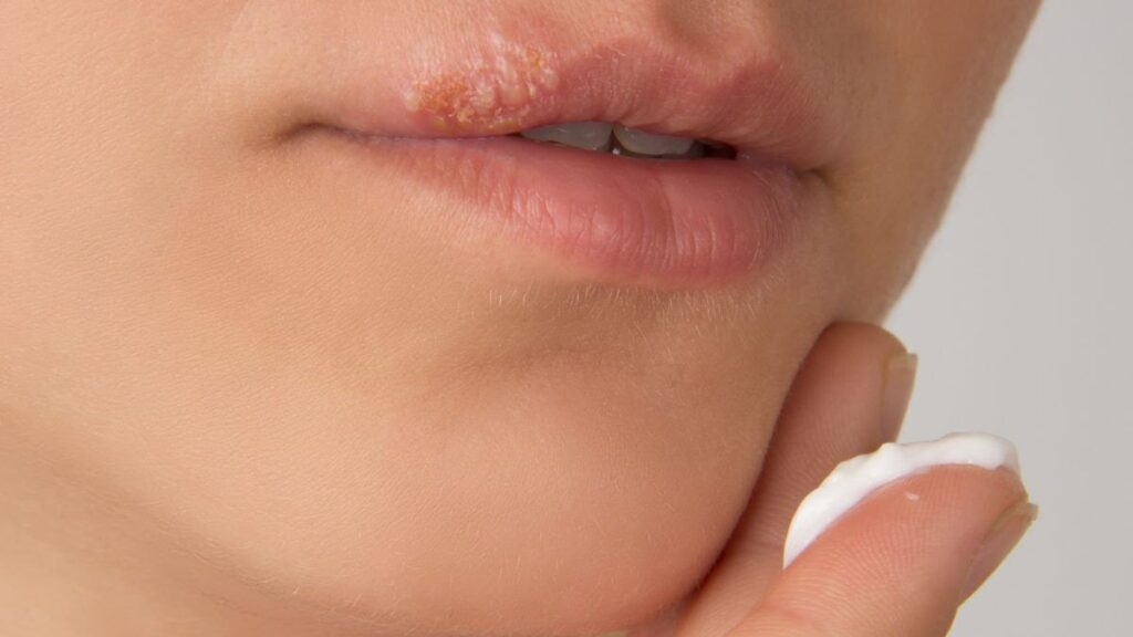 Is it OK to put Neosporin on herpes