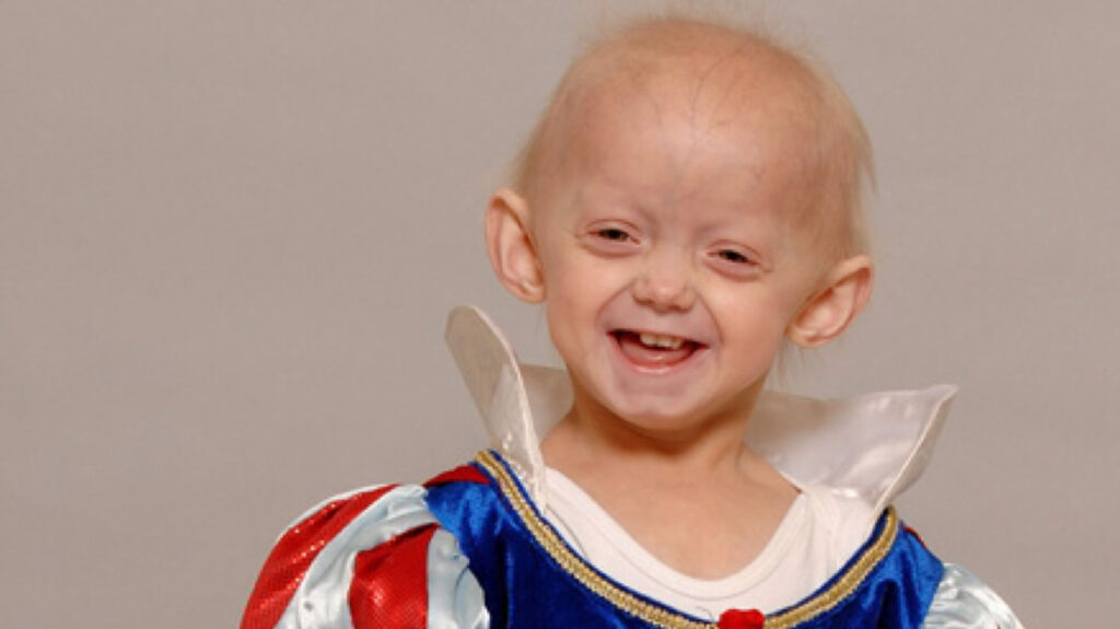 What are 3 symptoms of progeria
