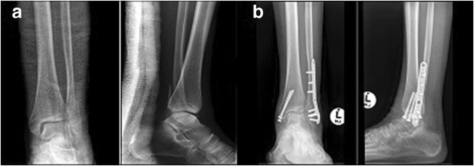 What is osteoclasis breakdown