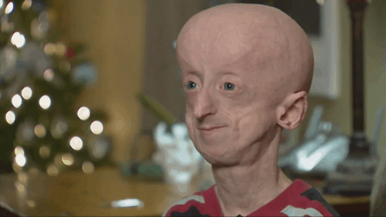 Who is the oldest progeria survivor