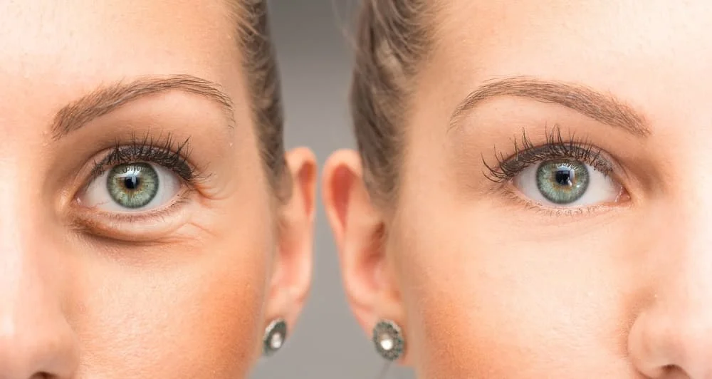 Botox Before and After Crows Feet