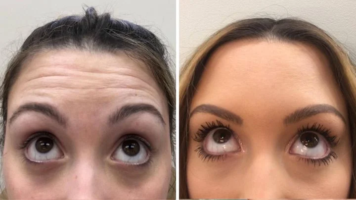 Botox Forehead Before and After
