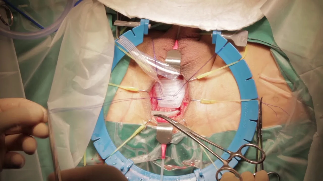 Male Sling Surgery Video