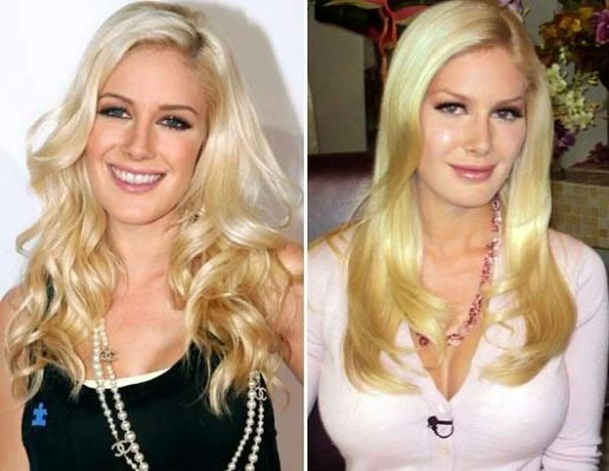 Heidi Montag Before and After Surgery