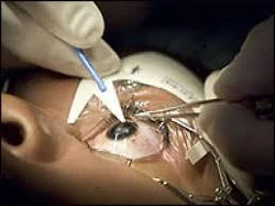 eye laser surgery price
